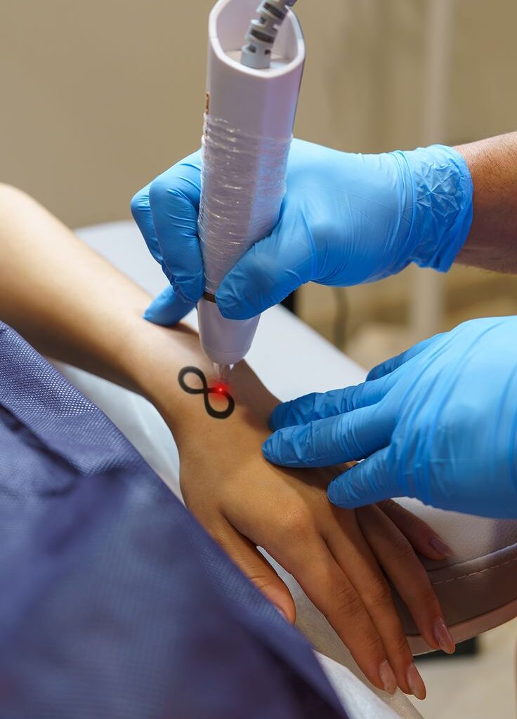 Gentle And Effective Laser Tattoo Removal For All Skin Types Erase My Ink 736x1024