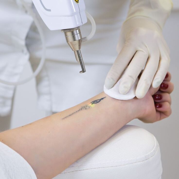 Laser Tattoo Removal At DermaEnvy Skincare E1769107298477