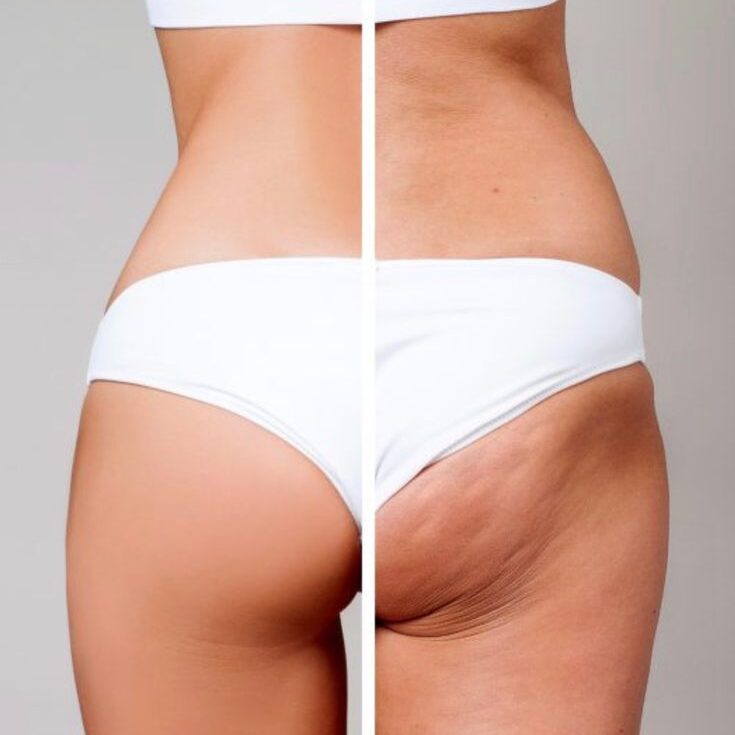 Zabiegi Kosmetyczne Na Cellulit W Krakowie E1769118072724